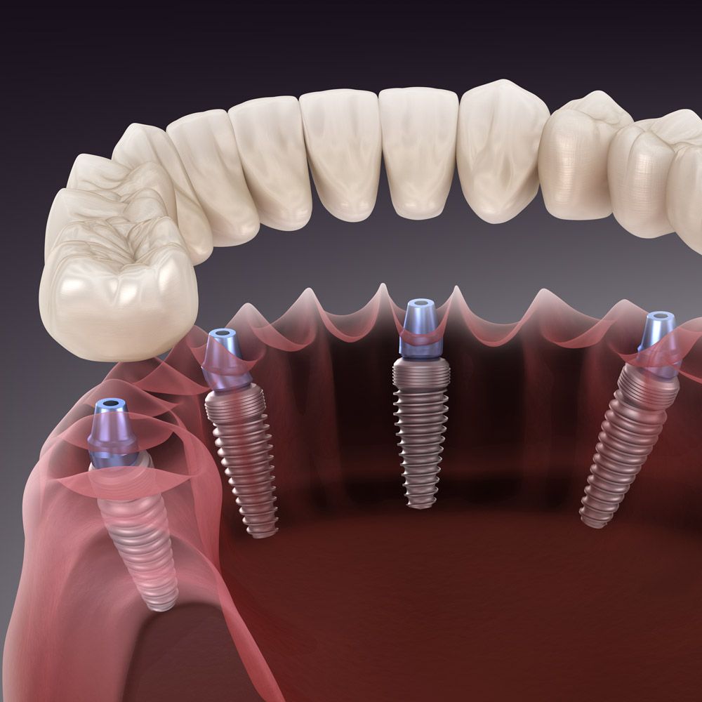 Dental Implant in Kolkata